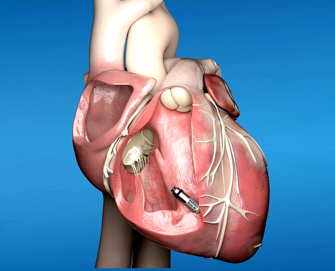 MEDTRONIC LAUNCHES MICRA™ AV, WORLD’S SMALLEST PACEMAKER WITH ...
